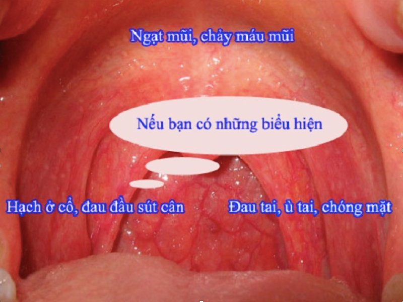 triệu chứng của ưng thư vòm họng